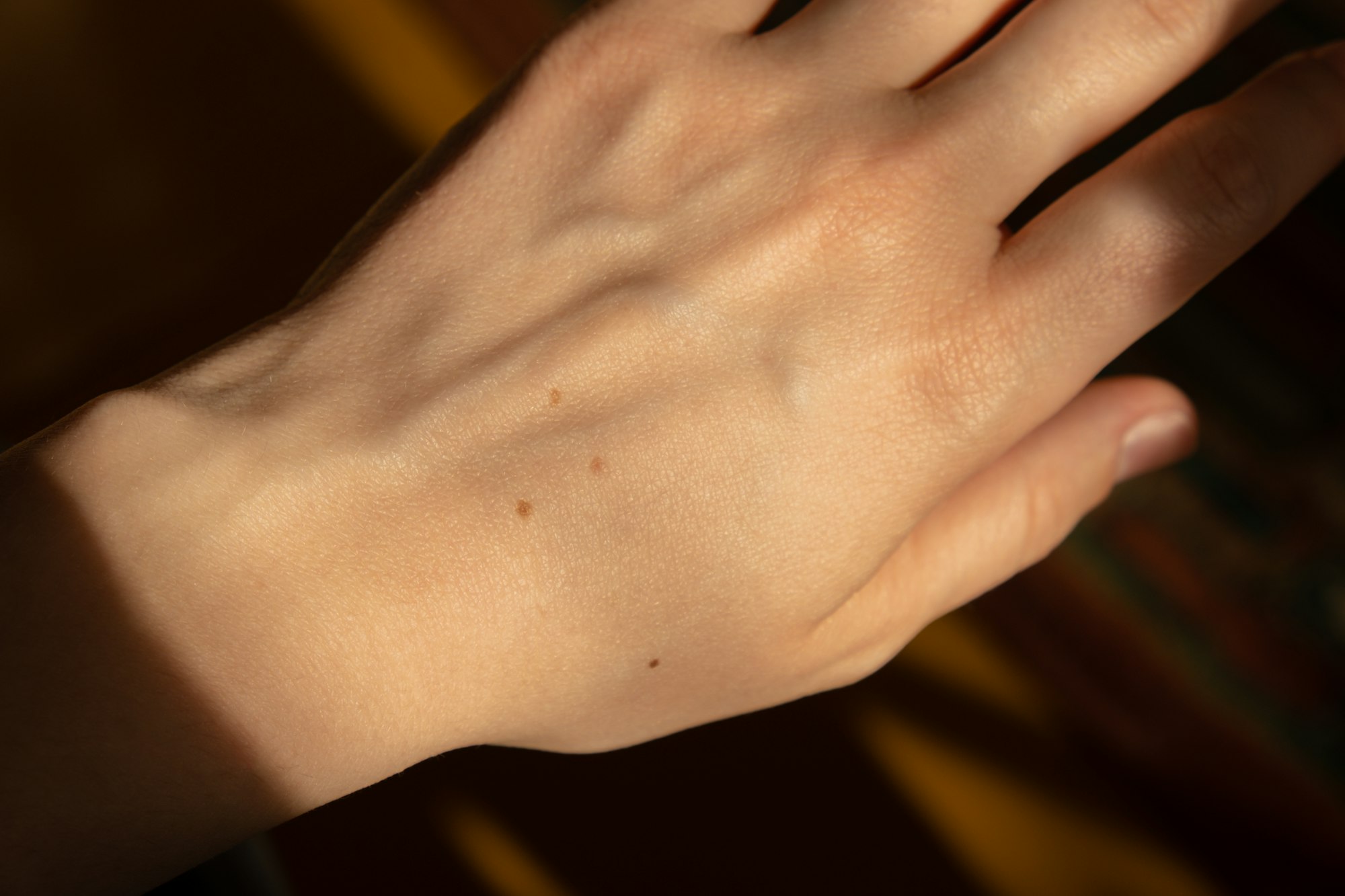 Birthmarks on skin Close up detail of the bare skin Sun Exposure effect on skin, Health Effects of